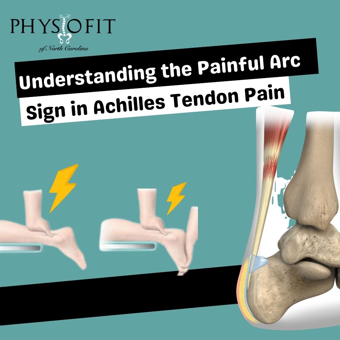 Understanding the Painful Arc Sign in Achilles Tendon Pain