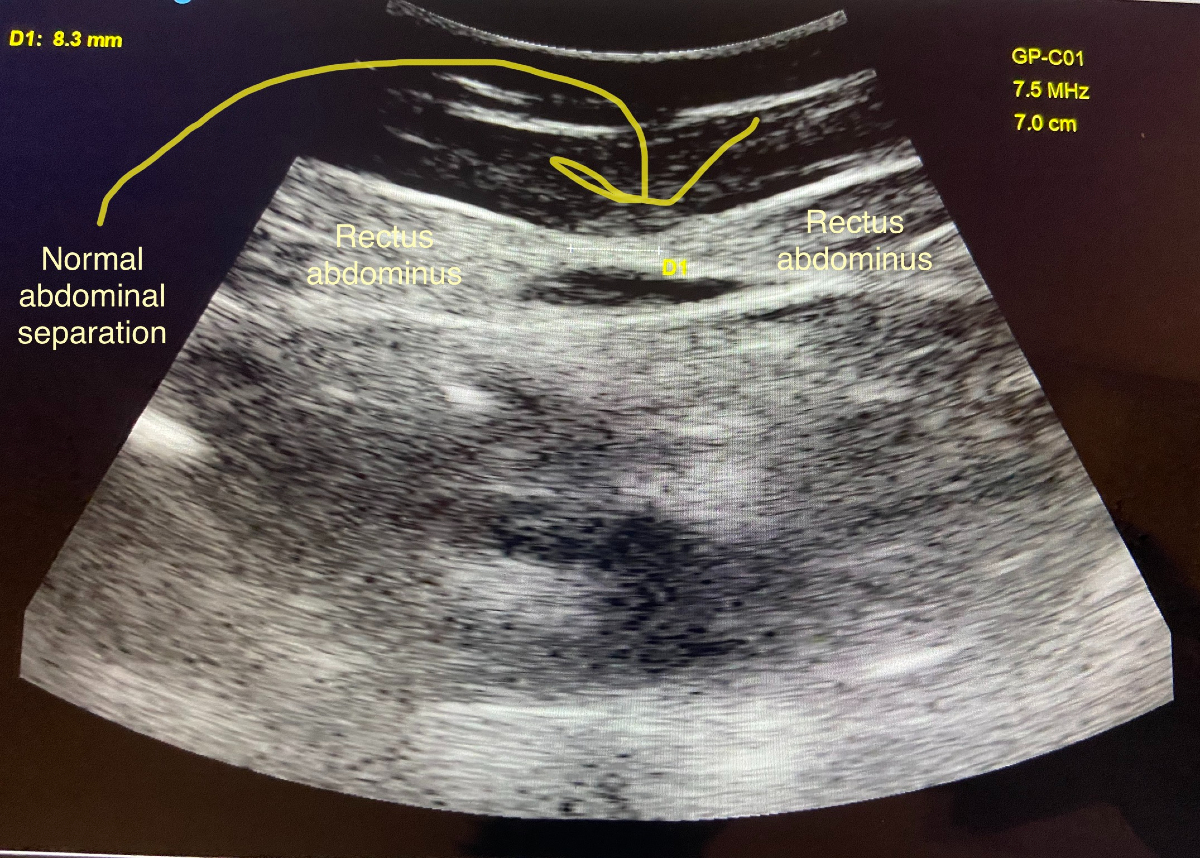 Ultrasound image of normal abdominal separation