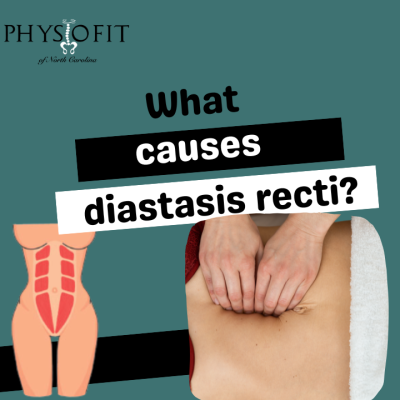 What causes Diastasis Recti?