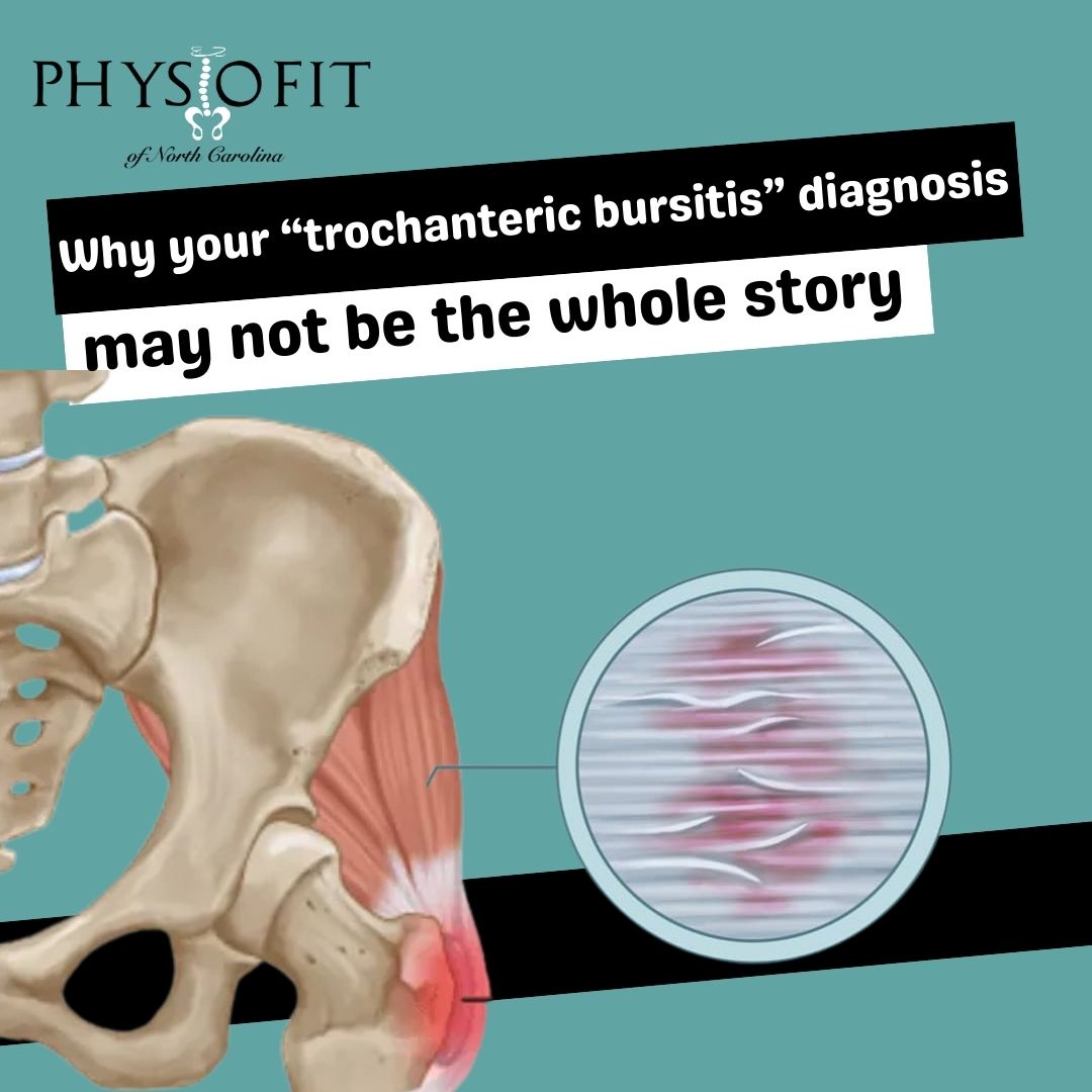 Why Your “Trochanteric Bursitis” Diagnosis May Not Be the Whole Story