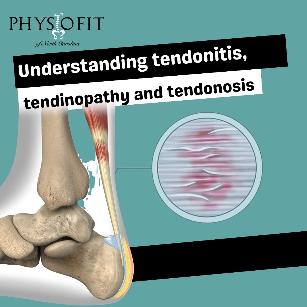 Understanding Achilles Tendonitis, Tendinopathy, and Tendinosis